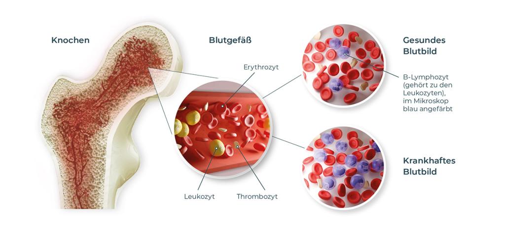 Blutzellen reifen im Knochenmark heran. Bei der chronischen lymphatischen Leukämie kommt es zu einer unkontrollierten Vermehrung von entarteten B-Lymphozyten, die nicht voll ausgereift beziehungsweise funktionsfähig sind. Zusätzlich ist die Lebensdauer der entarteten<br> B-Lymphozyten verlängert und der Körper wird von funktionsunfähigen weißen Blutkörperchen überschwemmt, welche die gesunden Lymphozyten verdrängen. Dadurch kommt es zu einer Schwächung des Immunsystems mit gesteigerter Infektanfälligkeit.