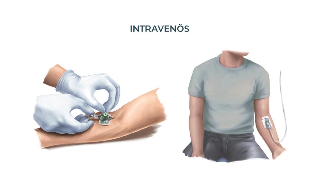 Bei der intravenösen Gabe werden Immunglobuline direkt in die Vene verabreicht.